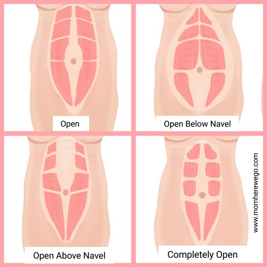 momherewego-diastasis-types